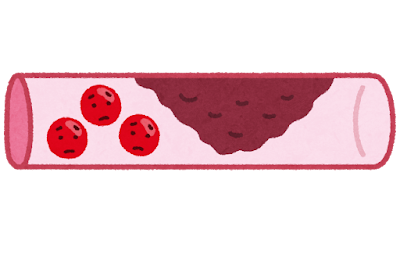 コレステロールと血管のイラスト