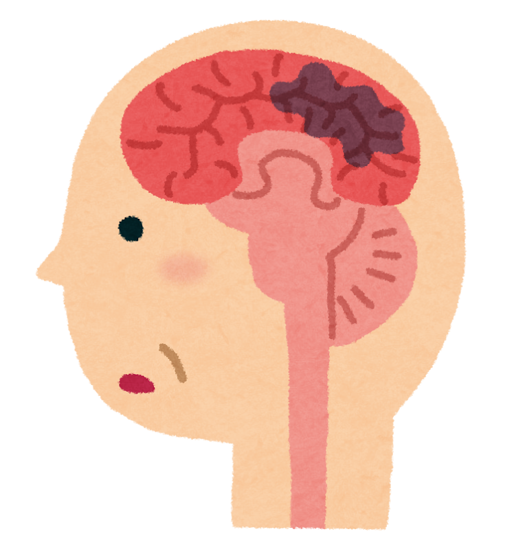 脳の血管のイラスト